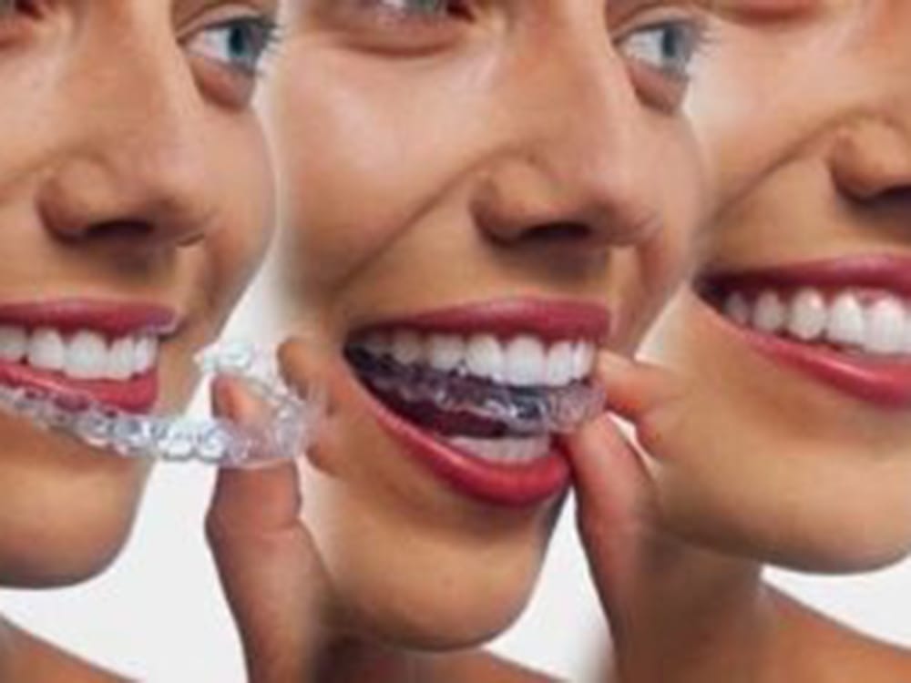 Dental aligner treatment and orthodontic procedure.