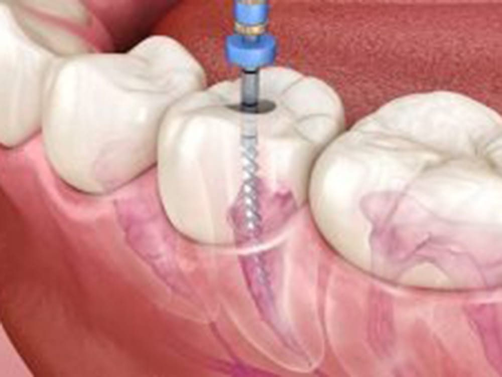 Close-up of a root canal dental procedure.